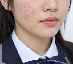 붉은 여드름자국